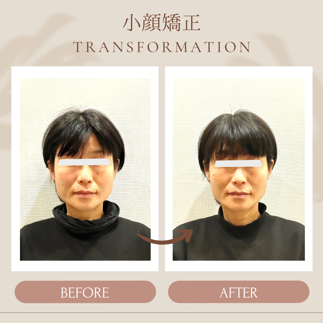 小顔矯正☆ビフォーアフター